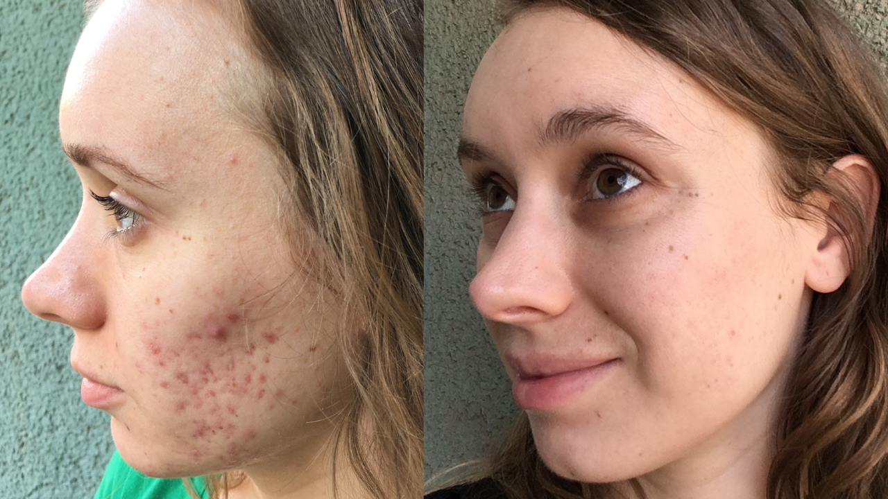 Anikó pattanásos arcbőre előtte utána képek.