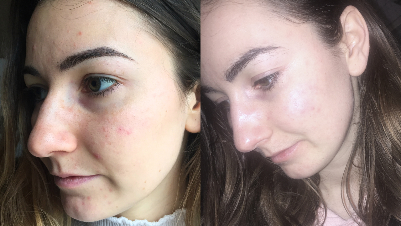 Bettina mitesszeres arcbőre előtte utána képek.