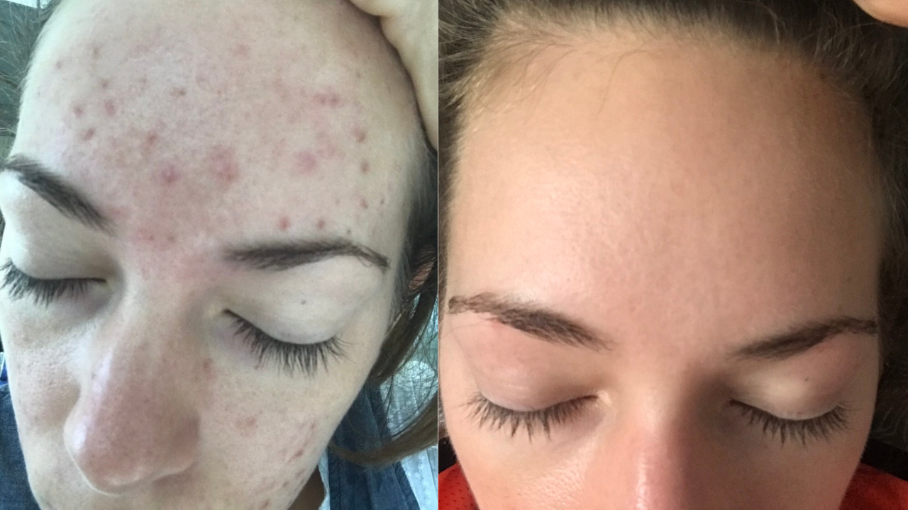 Bianka pattanásos arcbőre előtte utána képek.