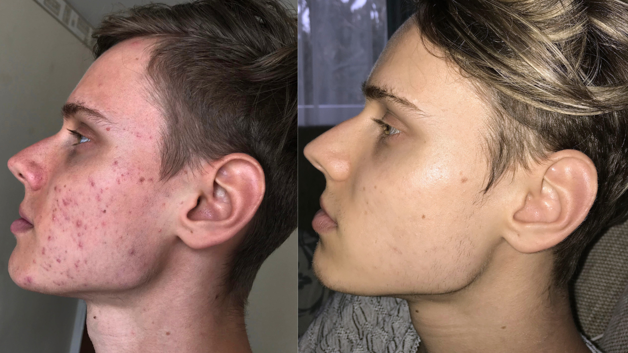 Dániel pattanásos arcbőre előtte utána képek.