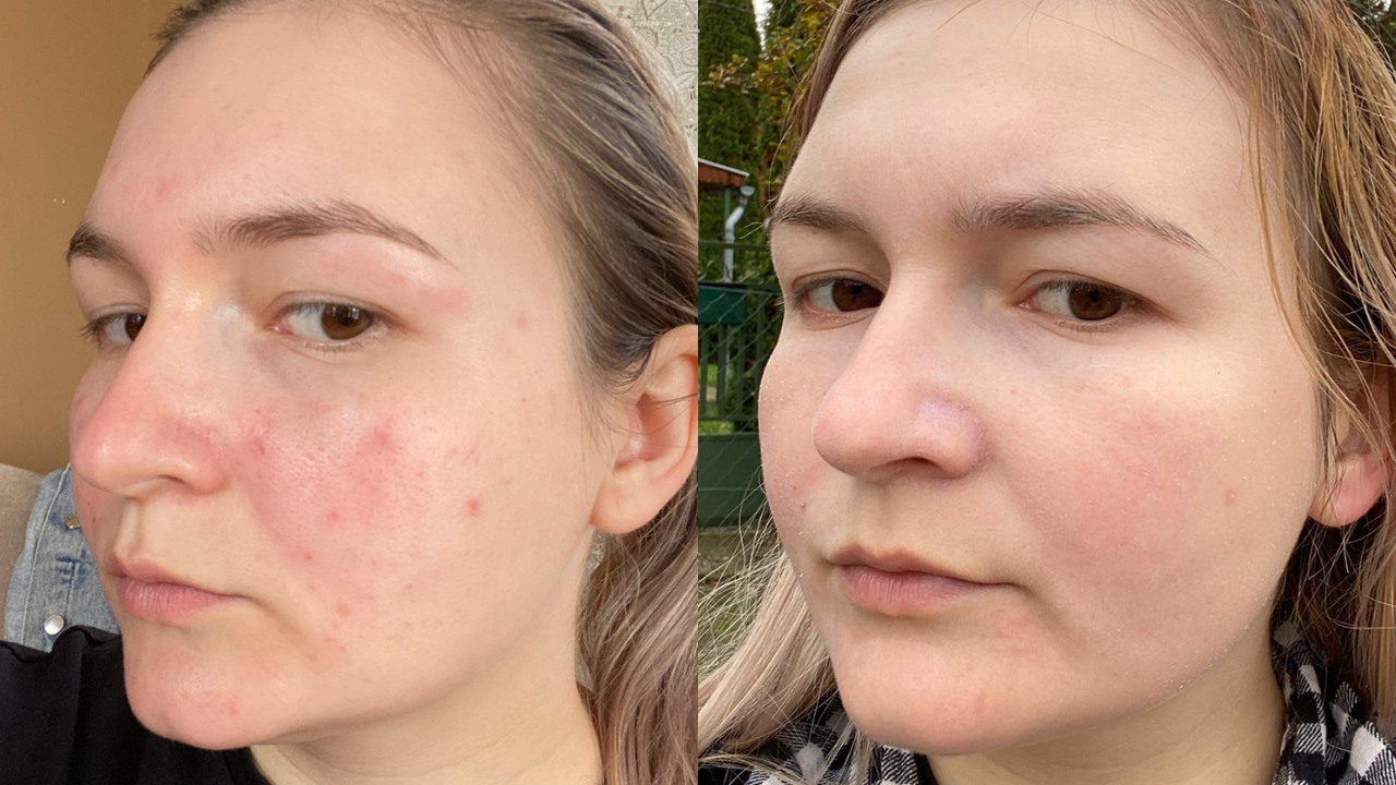 Enikő kipirosodára hajlamos és pattanásos bőre előtte utána képek.