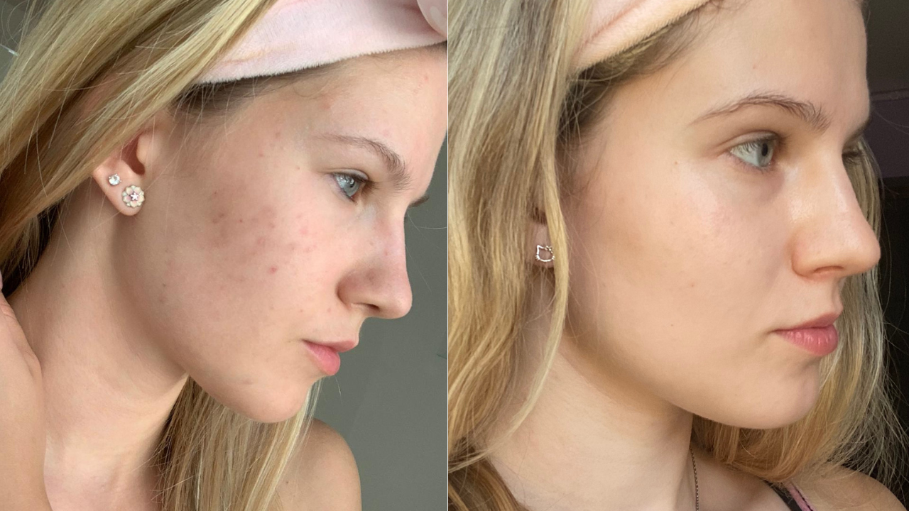 Gréti pattanás előtte utána képek