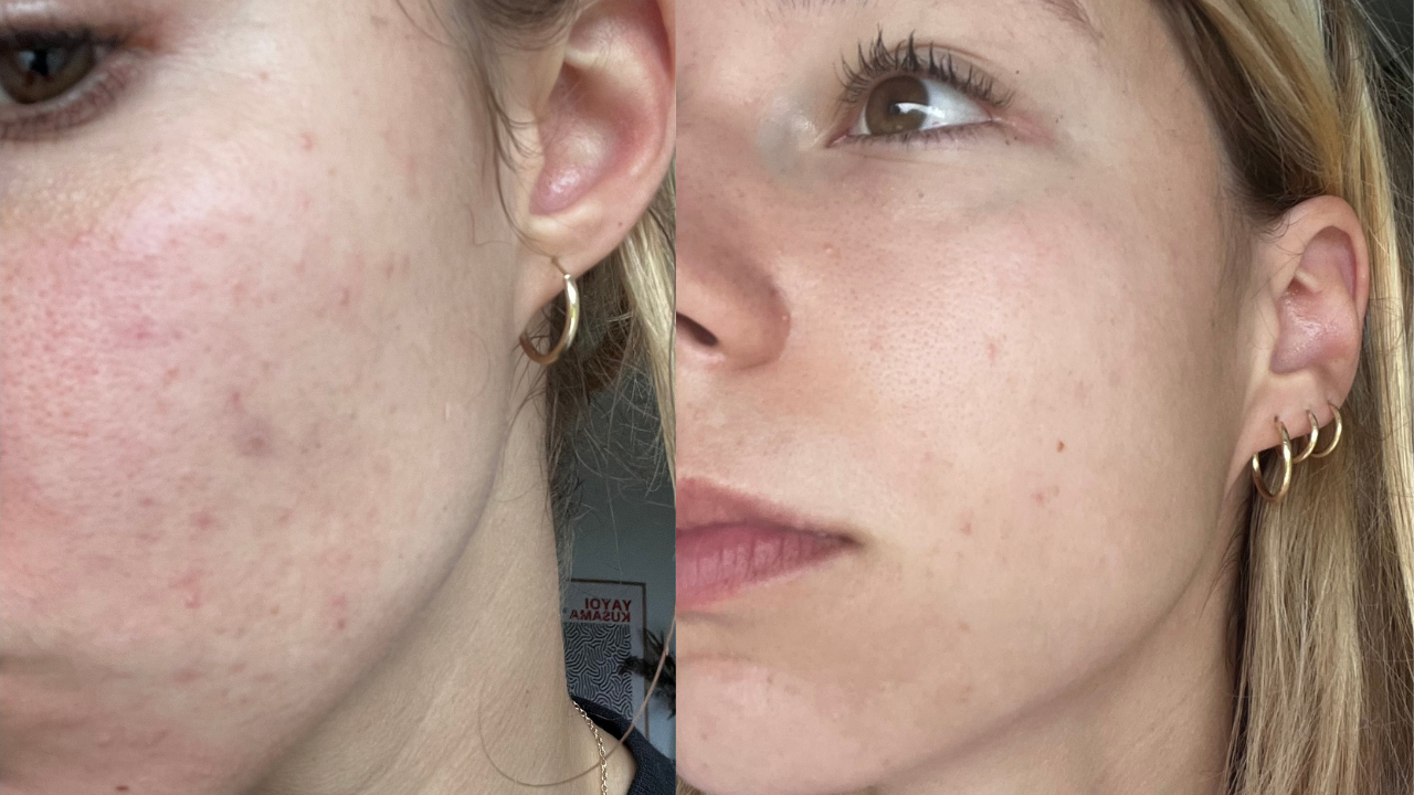 Katalin pattanásos arcbőre előtte utána képek.