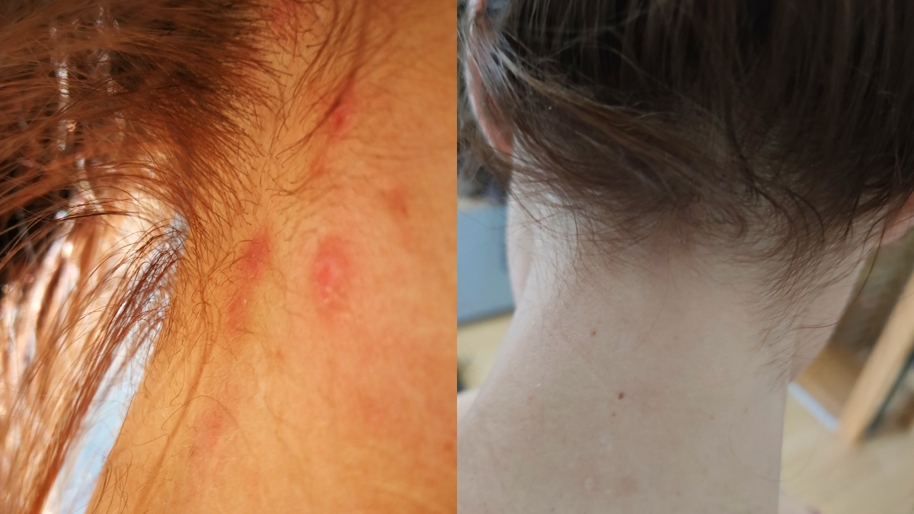 Krisztina pattanás, foltok nyakon előtte utána képek.