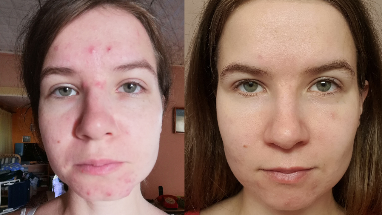 Lilla pattanásos arcbőre előtte utána képek.