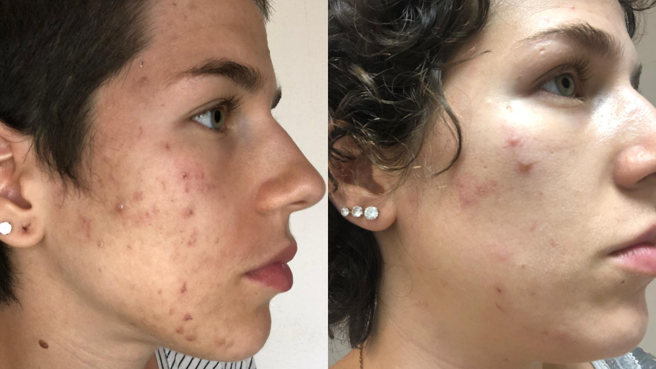 Nesrin pattanásos arcbőre előtte utána képek.