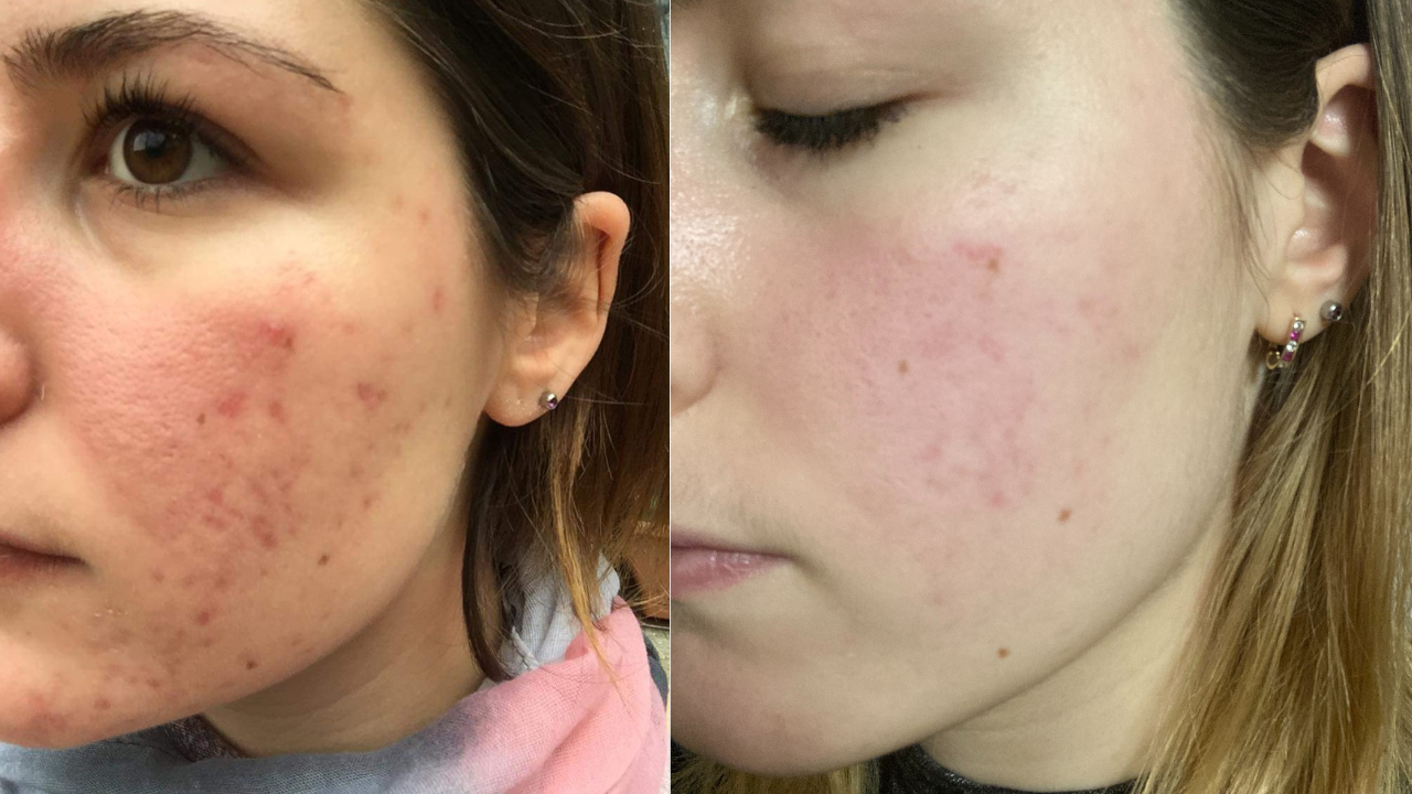 Petra pattanásos arcbőre előtte utána képek.