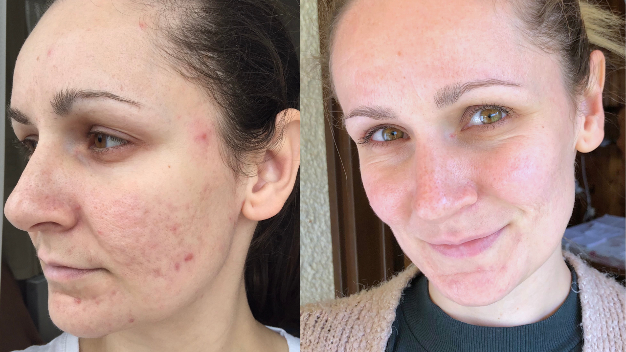 Tímea pattanásos arcbőre előtte utána képek.