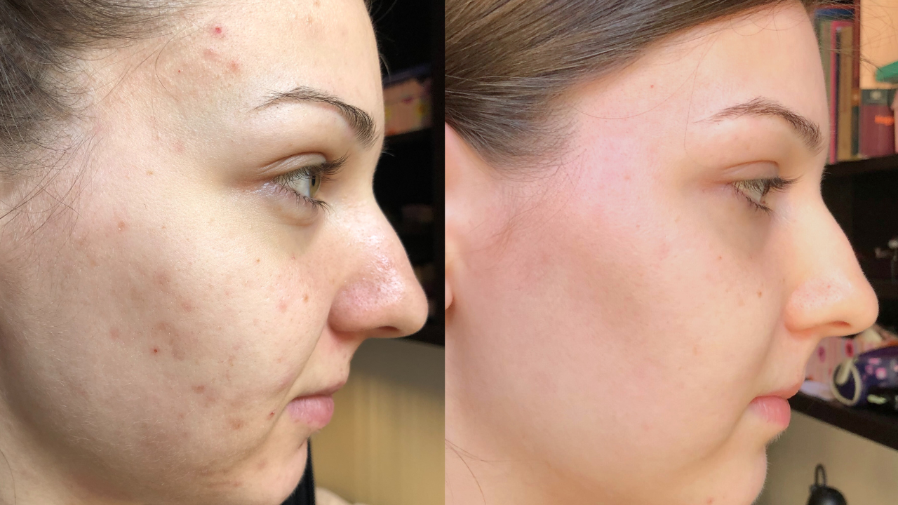 Vanda pattanásos arcbőre előtte utána képek.