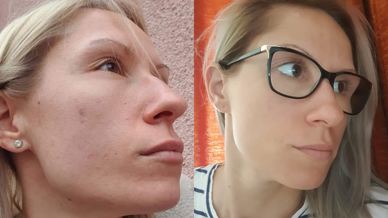 Viktória pattanásos bőre előtte utána képek.