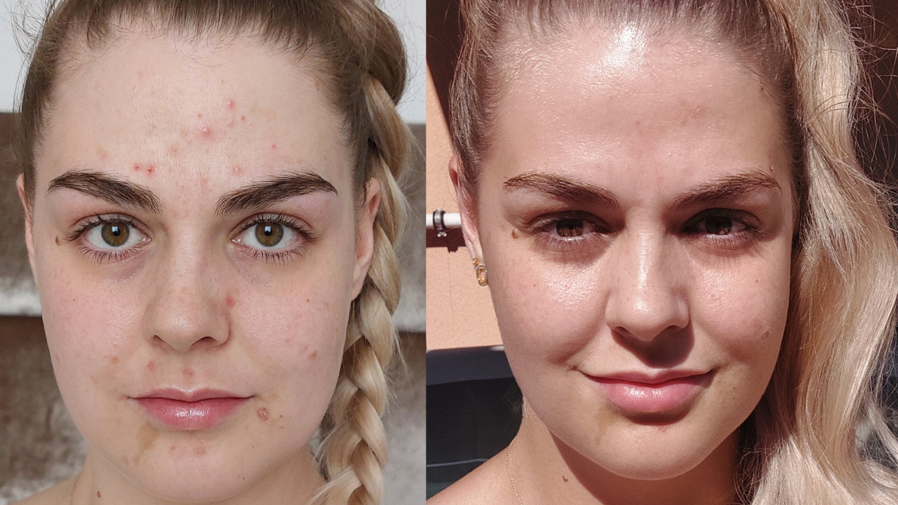 Zsanett pattanásos bőre előtte utána képek.