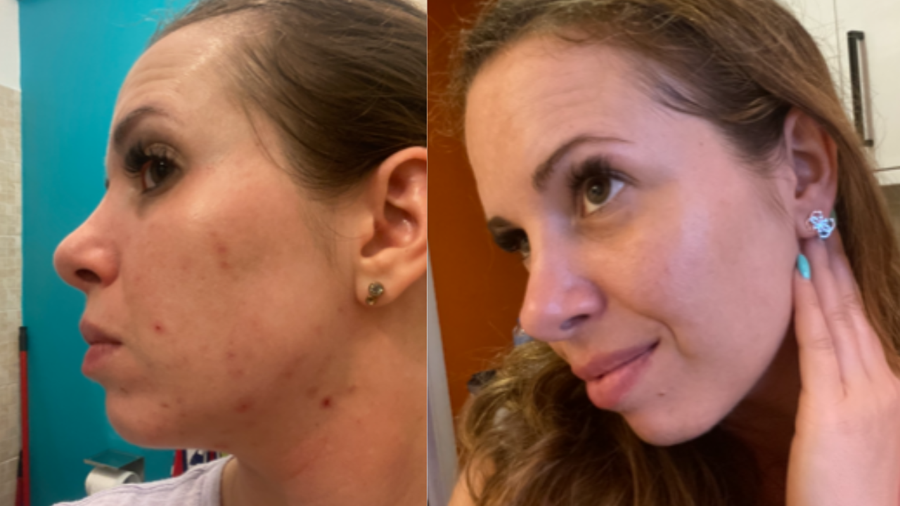 Zsuzsi arca akné vulgaris előtte utána képek.